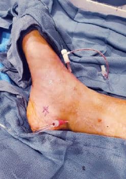 Figure 2. Retrograde 2.9 Fr ATA and 4-5 Fr PTA sheaths. ATA = anterior tibial artery; PTA = posterior tibial artery.