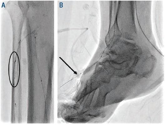 Figure 4. Oval (A) antegrade and retrograde wires in ATA and arrow (B) externalization of antegrade wire through the retrograde ATA access. ATA = anterior tibial artery.