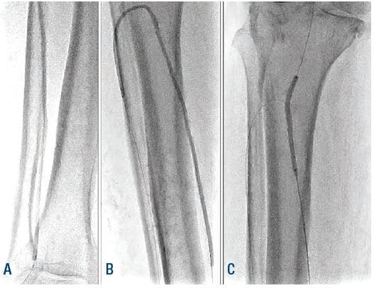 Figure 6. Angioplasty of ATA, PTA, and TPT. ATA = anterior tibial artery; PTA = posterior tibial artery; TPT = tibial peroneal trunk.