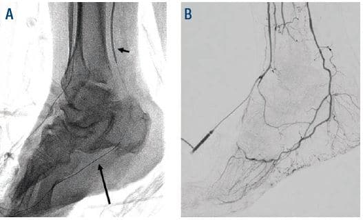Figure 7. (A) Short arrow points to PTA access balloon tamponade, long arrow is pointing at Fielder XT. (B) Successful hemostasis.