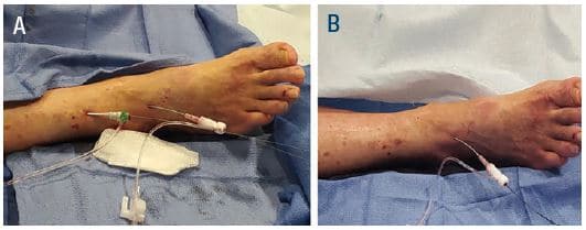 Figure 9. TAMI with a 5-6 Fr GSS and a distal 2.9 Fr sheath inserted at the end of the case for balloon tamponade of the 5-6 Fr sheath with 3.0 mm Advance Micro (Cook) balloon. GSS = Glidesheath Slender (Terumo Medical).